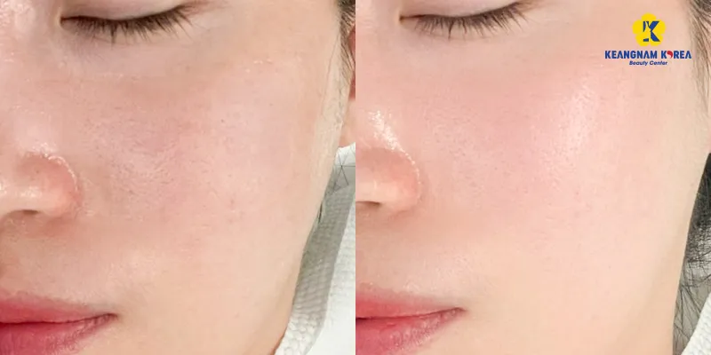Tiêm meso là gì? Giá bao nhiêu? Gồm những phương pháp nào? 3 Tiêm meso căng bón