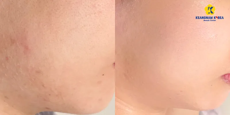Tiêm meso phục hồi da sau bao lâu thì có kết quả? Đặc trị các trường hợp nào? Giá bao nhiêu? 3 Tiêm meso phục hồi da sau bao lâu thì có kết quả