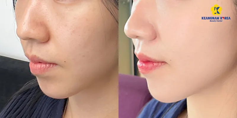 Tiêm meso là gì? Giá bao nhiêu? Gồm những phương pháp nào? 4 Tiêm meso trắng da