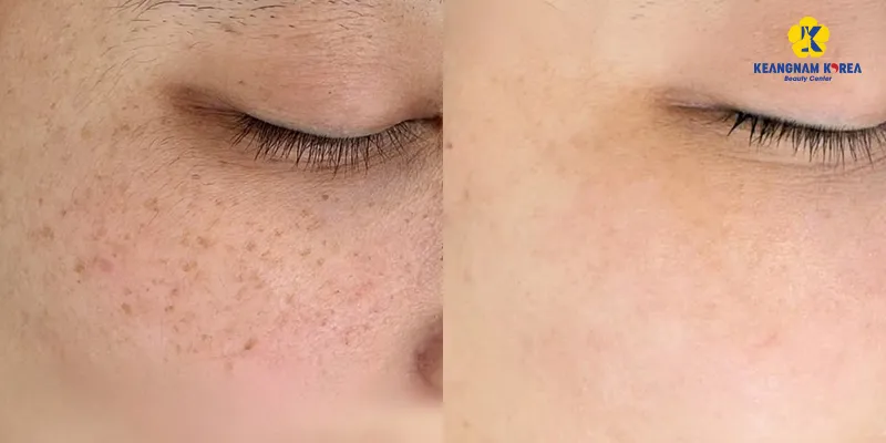 Tiêm meso trị nám có hiệu quả không? Bao lâu thì hết? Tác dụng phụ là gì? 5 Tiêm meso trị nám