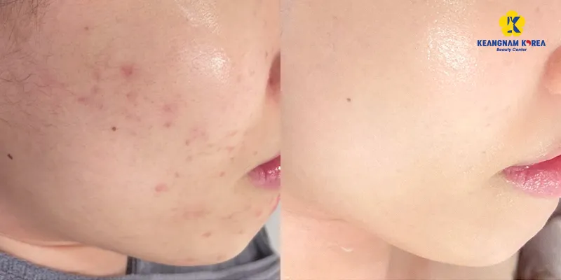 Tiêm meso là gì? Giá bao nhiêu? Gồm những phương pháp nào? 5 Tiêm meso trị sẹo mụn