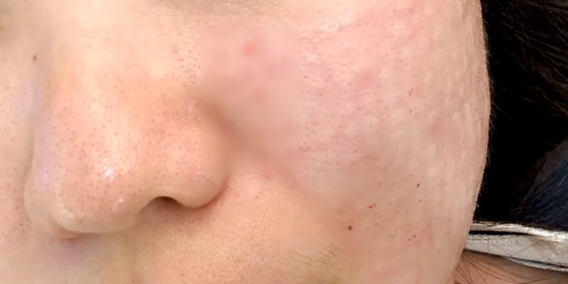 Tiêm meso trị sẹo rỗ có hiệu quả không? Bao lâu thì hết? Phù hợp với các cấp độ nào? 3 tiem meso tri seo ro 1