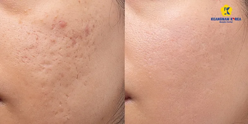 Tiêm meso trị sẹo rỗ có hiệu quả không? Bao lâu thì hết? Phù hợp với các cấp độ nào? 2 hình ảnh Tiêm meso trị sẹo rỗ