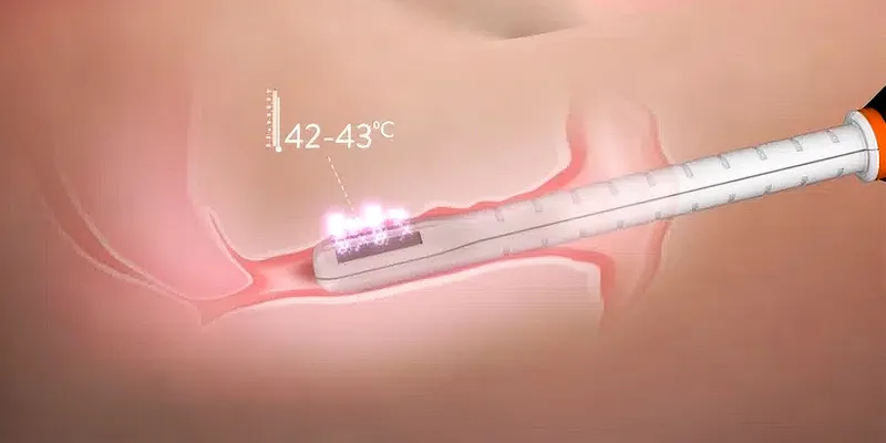 Trẻ hóa vùng kín bằng laser có hiệu quả gì? Khi nào nên thực hiện? 4 trẻ hóa vùng kín bằng laser