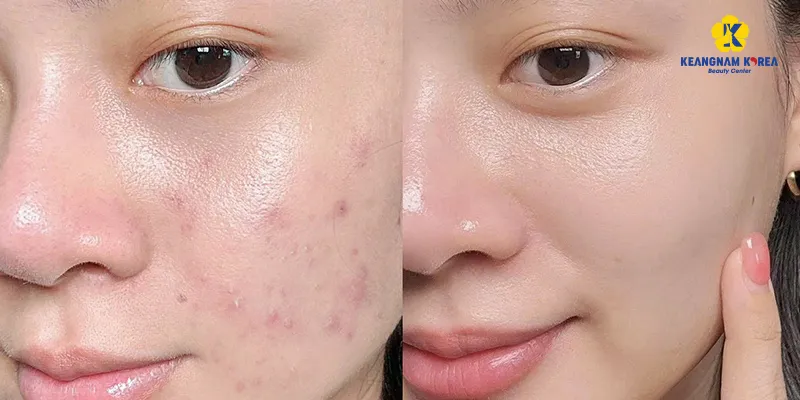 Ưu nhược điểm của tiêm meso là gì? Có an toàn không? Khi nào nên thực hiện 2 Ưu nhược điểm của tiêm meso là gì