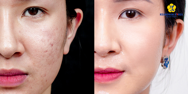 4 cách tái tạo collagen cho da mặt cho phụ nữ trong từng độ tuổi 4 4 cách tái tạo collagen cho da mặt