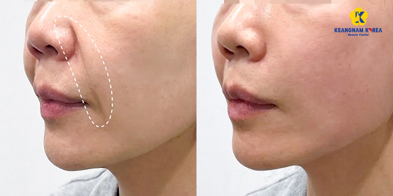 Căng chỉ nâng cơ mặt là gì? Hiệu quả, quy trình, ai thật sự phù hợp? 3 căng chỉ nâng cơ mặt