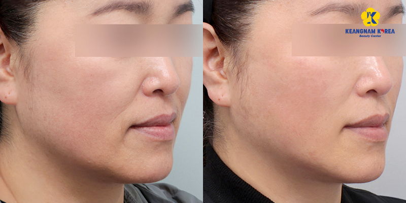 Căng chỉ nâng cơ mặt giá bao nhiêu? Bảng giá theo loại chỉ và khu vực thực hiện 4 Căng chỉ nâng cơ mặt giá bao nhiêu