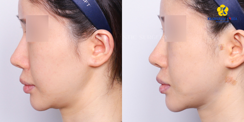Căng chỉ nâng cơ mặt giá bao nhiêu? Bảng giá theo loại chỉ và khu vực thực hiện 3 Căng chỉ nâng cơ mặt giá bao nhiêu