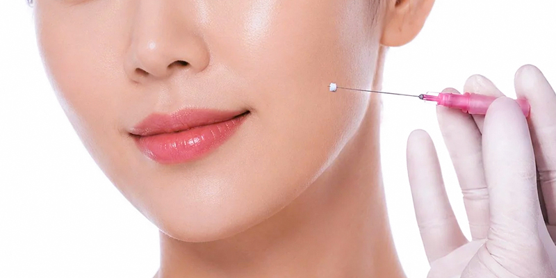 Căng chỉ nâng cơ mặt là gì
