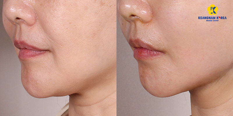 Căng chỉ rãnh cười có hiệu quả không? Khi nào nên chọn thay vì tiêm filler 3 căng chỉ rãnh cười