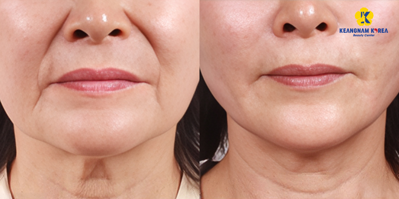 Căng chỉ rãnh cười có hiệu quả không? Khi nào nên chọn thay vì tiêm filler 2 căng chỉ rãnh cười