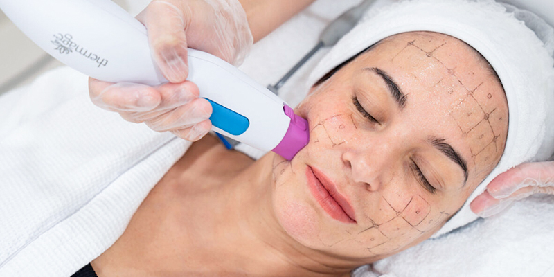 Căng da Thermage là gì? Cơ chế, hiệu quả thực tế và bảng giá mới nhất 2026 3 căng da thermage