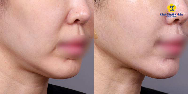 Căng da Thermage là gì? Cơ chế, hiệu quả thực tế và bảng giá mới nhất 2026 4 căng da thermage