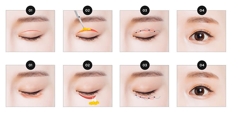 Cắt da thừa mí mắt ở đâu đẹp? 6 tiêu chí chọn đúng cơ sở thẩm mỹ "mát tay" 3 cắt da thừa mí mắt ở đâu đẹp