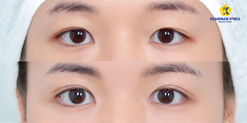Cắt da thừa mí mắt ở đâu đẹp? 6 tiêu chí chọn đúng cơ sở thẩm mỹ "mát tay" 6 cắt da thừa mí mắt ở đâu đẹp