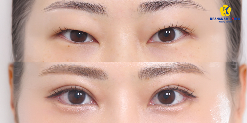 Cắt da thừa mí mắt ở đâu đẹp? 6 tiêu chí chọn đúng cơ sở thẩm mỹ "mát tay" 7 cắt da thừa mí mắt ở đâu đẹp