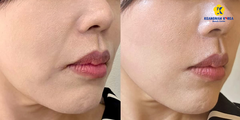 HIFU là gì? Trẻ hóa da bằng công nghệ HIFU có hiệu quả không? 3 công nghệ HIFU có hiệu quả không