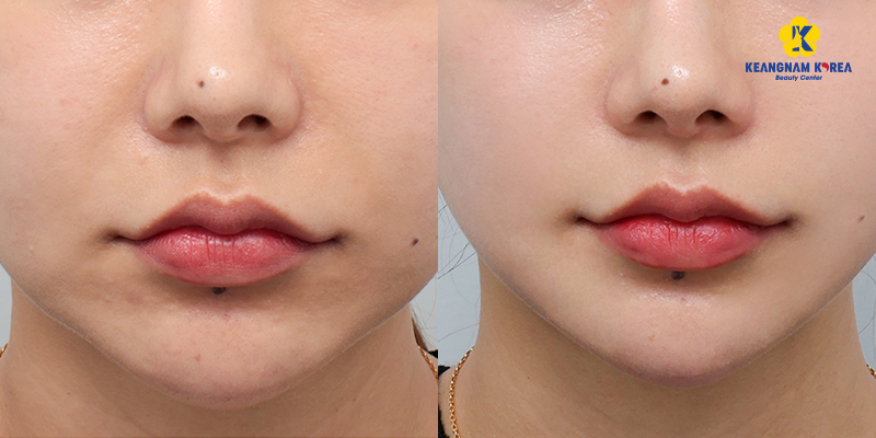 Công nghệ Ultherapy có tốt không? Tác dụng là gì? Ưu nhược điểm cần biết và bảng giá mới nhất hiện nay 3 công nghệ Ultherapy