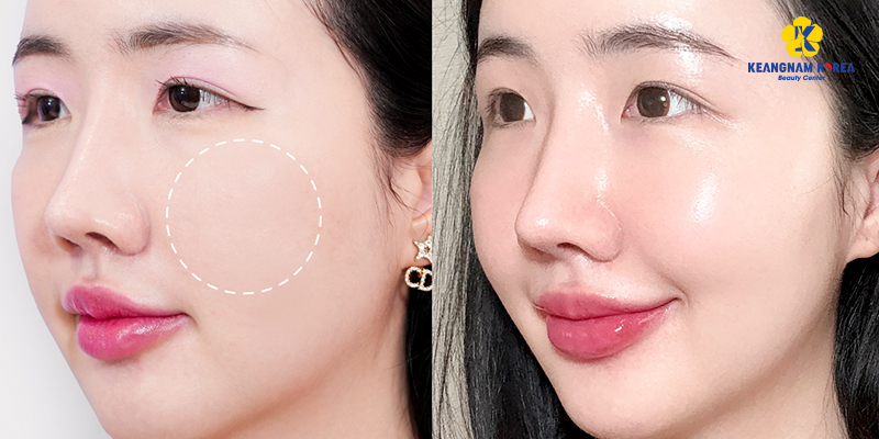 Căng bóng da mặt gồm những phương pháp nào? Đâu là lựa chọn phù hợp cho bạn? 2 Căng bóng da mặt gồm những phương pháp nào