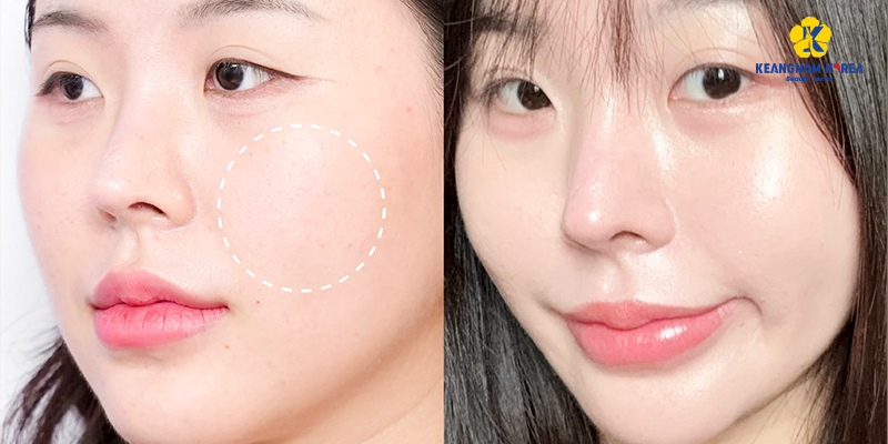 Căng bóng da mặt gồm những phương pháp nào? Đâu là lựa chọn phù hợp cho bạn? 3 Căng bóng da mặt gồm những phương pháp nào