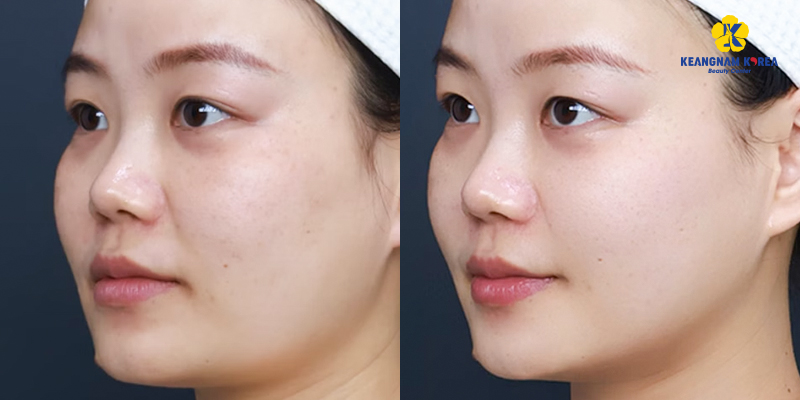 Phương pháp Thermage có tác dụng gì trong trẻ hóa da mặt? Ưu nhược điểm là gì? Tối ưu khi nào? Bảng giá mới nhất 2026 4 Phương pháp Thermage có tác dụng gì trong trẻ hóa da mặt
