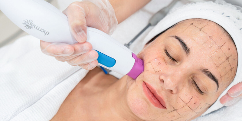 Phương pháp Thermage có tác dụng gì trong trẻ hóa da mặt? Ưu nhược điểm là gì? Tối ưu khi nào? Bảng giá mới nhất 2026 2 Phương pháp Thermage có tác dụng gì trong trẻ hóa da mặt