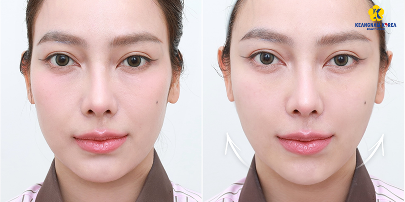 Nên tiêm collagen hay căng chỉ da mặt để khắc phục tình trạng chảy xệ 4 Nên tiêm collagen hay căng chỉ da mặt