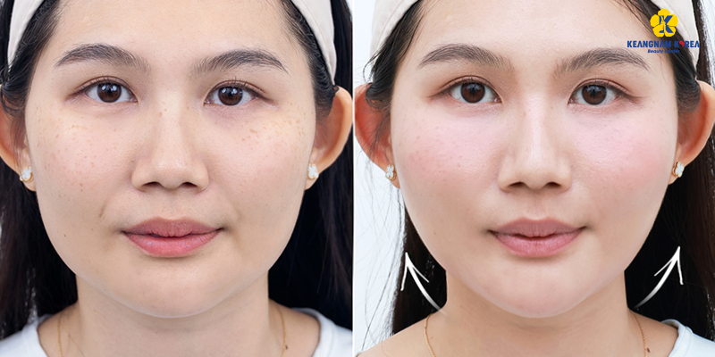 Nên tiêm collagen hay căng chỉ da mặt để khắc phục tình trạng chảy xệ 6 Nên tiêm collagen hay căng chỉ da mặt