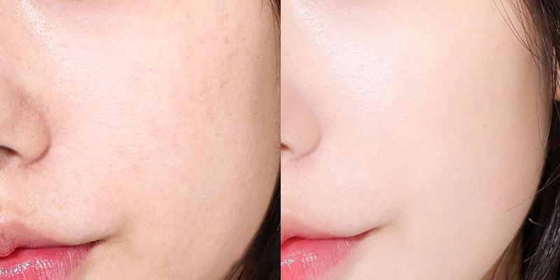 Tiêm trẻ hóa da Dermazeen là gì? Cơ chế, hiệu quả và đối tượng phù hợp 3 tiêm trẻ hóa da Dermazeen