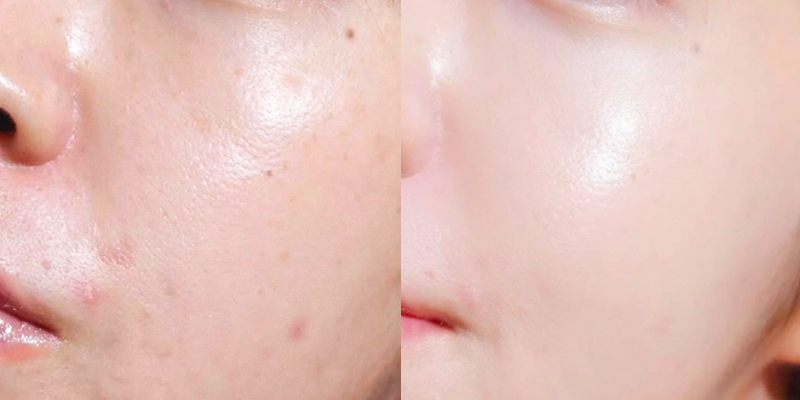 Tiêm trẻ hóa da Dermazeen là gì? Cơ chế, hiệu quả và đối tượng phù hợp 4 tiêm trẻ hóa da Dermazeen