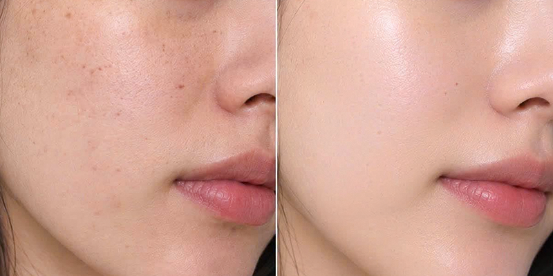 So sánh tiêm collagen gân ngựa và collagen cá hồi 4 So sánh tiêm collagen gân ngựa và collagen cá hồi
