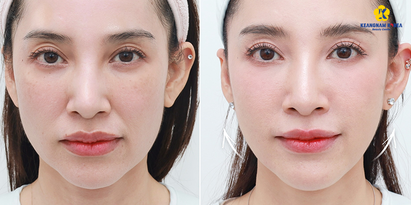 Nên tiêm collagen hay căng chỉ da mặt để khắc phục tình trạng chảy xệ 5 Nên tiêm collagen hay căng chỉ da mặt