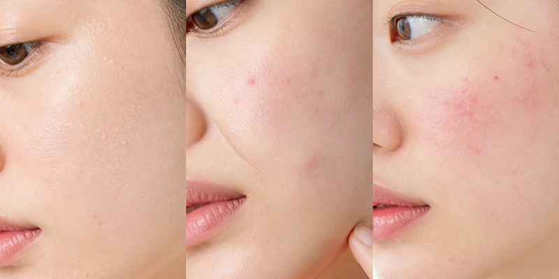 Collagen Injections for Face: Benefits, Results & Cost in Ho Chi Minh City 6 Collagen Injections for Face
