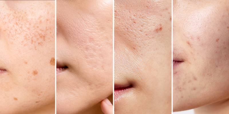 Tiêm collagen trẻ hóa da hay laser tốt hơn? 3 Tiêm collagen trẻ hóa da hay laser tốt hơn?