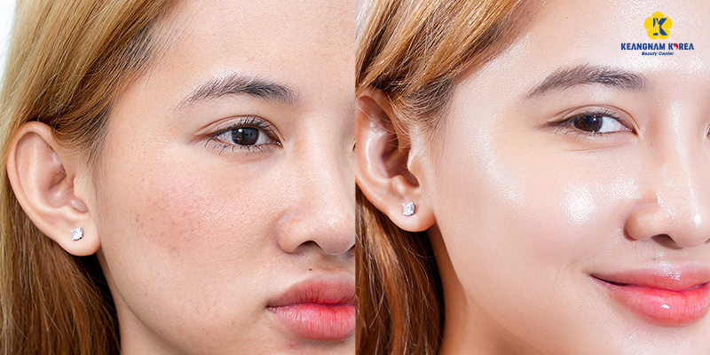 Tiêm collagen trẻ hóa da hay laser tốt hơn? 5 Tiêm collagen trẻ hóa da hay laser tốt hơn?
