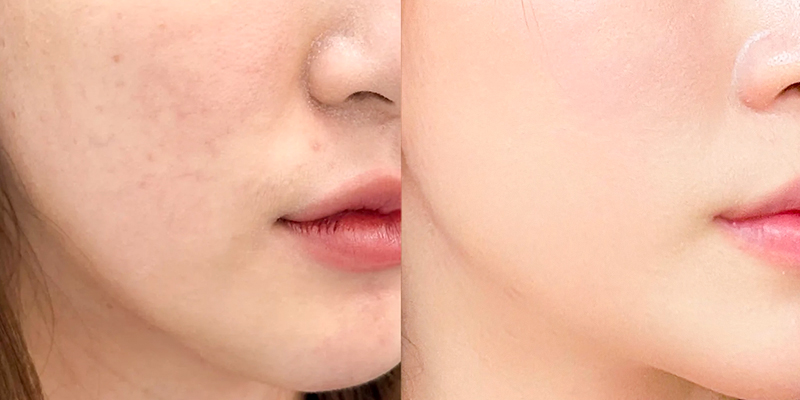 Tiêm collagen trẻ hóa da sau sinh: bao lâu thì tiêm được, chi phí và đối tượng phù hợp 4 Tiêm collagen trẻ hóa da sau sinh