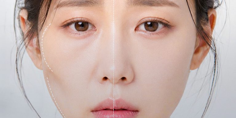 Tiêm collagen trẻ hóa da sau sinh
