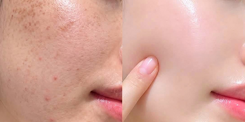 Tiêm collagen tươi là gì? 5 loại collagen tiêm da mặt phổ biến và cách lựa chọn đúng với dấu hiệu lão hóa 5 tiem collagen tuoi 3