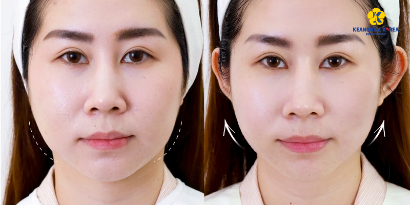 Tiêm collagen và HIFU, phương pháp nào tốt hơn? 5 Tiêm collagen và HIFU phương pháp nào tốt hơn