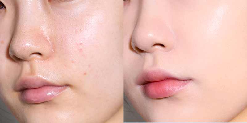 Tiêm collagen và tiêm meso: 4 điểm khác biệt quyết định hiệu quả trẻ hóa da mặt 2 tiem collagen va tiem meso 2