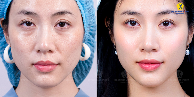 Tiêm trẻ hóa da Dermazeen là gì? Cơ chế, hiệu quả và đối tượng phù hợp 7 tiêm trẻ hóa da Dermazeen