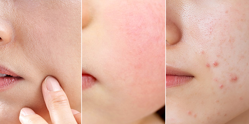 Tiêm trẻ hóa da Dermazeen là gì? Cơ chế, hiệu quả và đối tượng phù hợp 5 tiêm trẻ hóa da Dermazeen