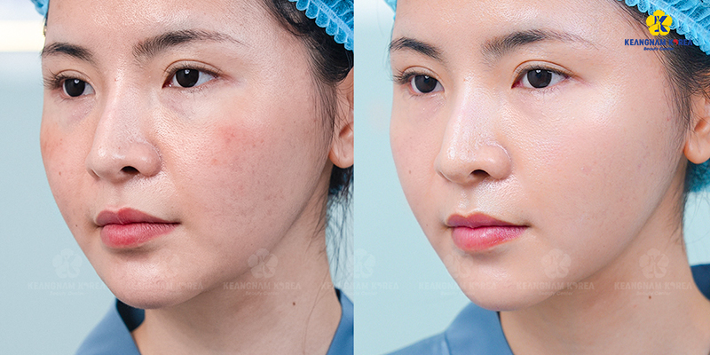 Tiêm trẻ hóa da Dermazeen là gì? Cơ chế, hiệu quả và đối tượng phù hợp 8 tiêm trẻ hóa da Dermazeen