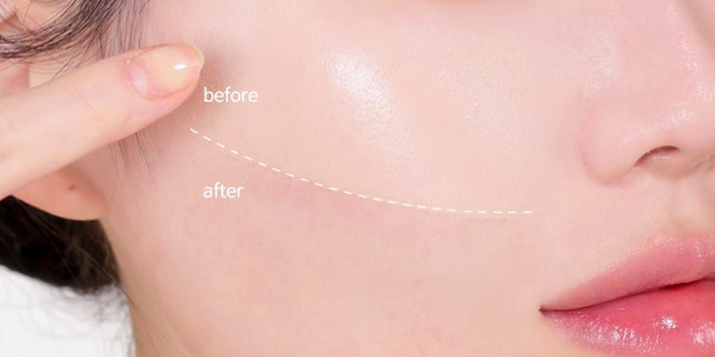 Tiêm trẻ hóa da Dermazeen là gì? Cơ chế, hiệu quả và đối tượng phù hợp 1 tiêm trẻ hóa da Dermazeen