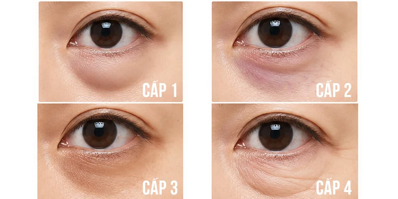 Bọng Mắt Chảy Xệ Phải Làm Sao
