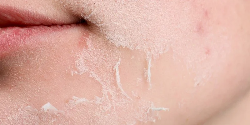 Dermazeen có thể được phối hợp với Laser, RF, PRP hoặc Microneedling trong phác đồ điều trị nhằm hỗ trợ tái tạo nền da
