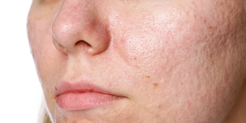 Da có sẹo rỗ hoặc bề mặt da kém mịn