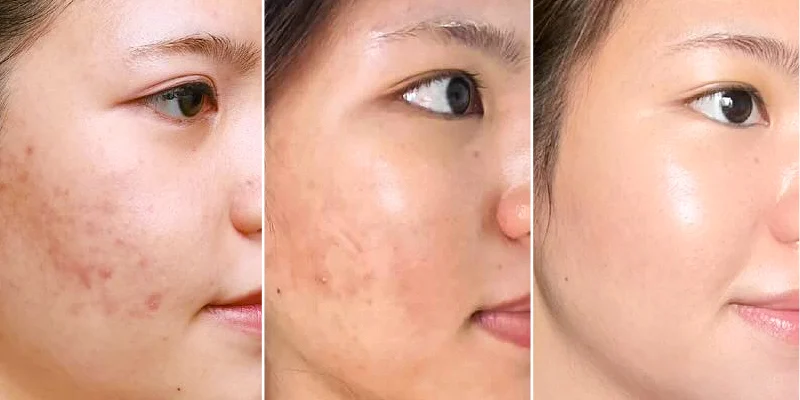 Tiêm meso có trị mụn không?