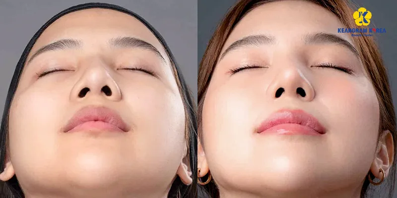 Alar Base Reduction Technique: Rolling vs. Excision Comparison 2 Alar Base Reduction Technique